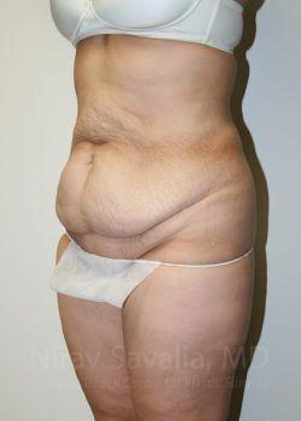 Body Contouring after Weight Loss Before & After Gallery - Patient 1655611 - Before1