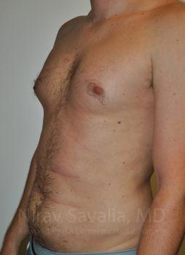 Male Breast Reduction Before & After Gallery - Patient 1655612 - Before1