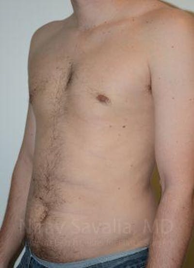Male Breast Reduction Before & After Gallery - Patient 1655612 - After1
