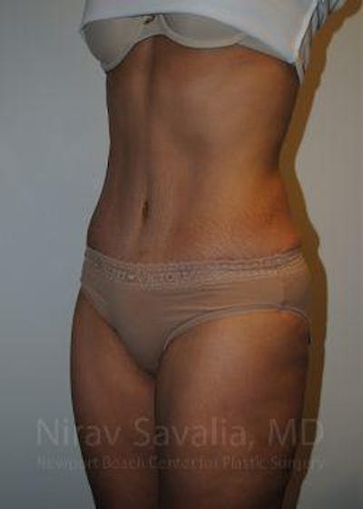 Body Contouring after Weight Loss Before & After Gallery - Patient 1655611 - After1