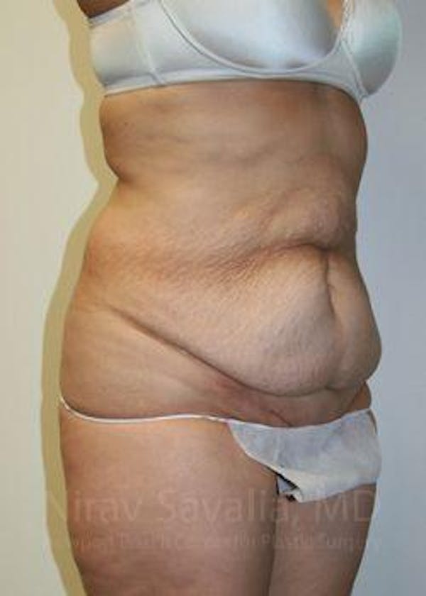 Body Contouring after Weight Loss Before & After Gallery - Patient 1655611 - Before1