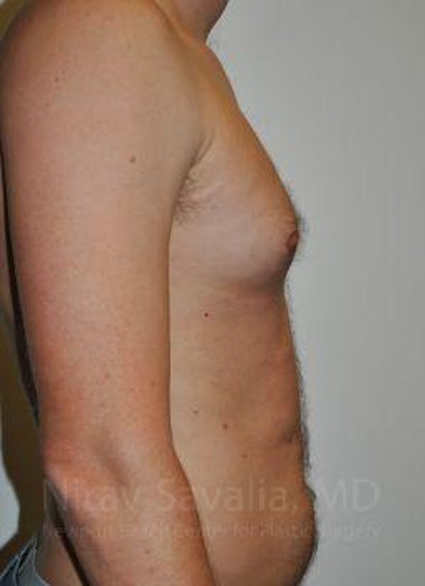 Male Breast Reduction Before & After Gallery - Patient 1655612 - Before1