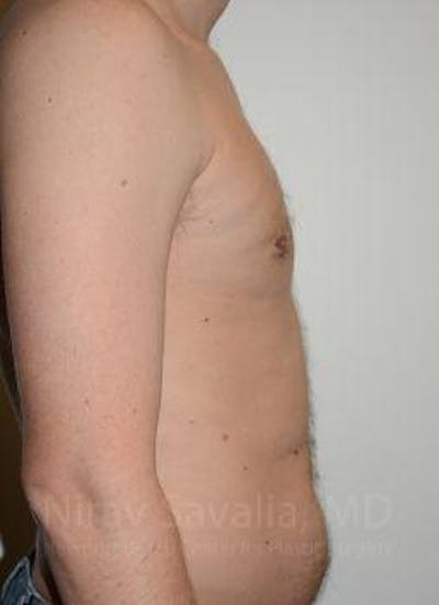 Male Breast Reduction Before & After Gallery - Patient 1655612 - After1