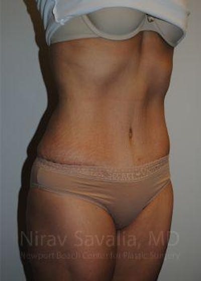 Body Contouring after Weight Loss Before & After Gallery - Patient 1655611 - After1