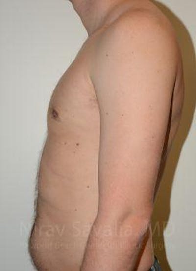 Male Breast Reduction Before & After Gallery - Patient 1655612 - After1