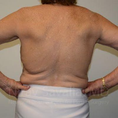Body Contouring after Weight Loss Before & After Gallery - Patient 1655616