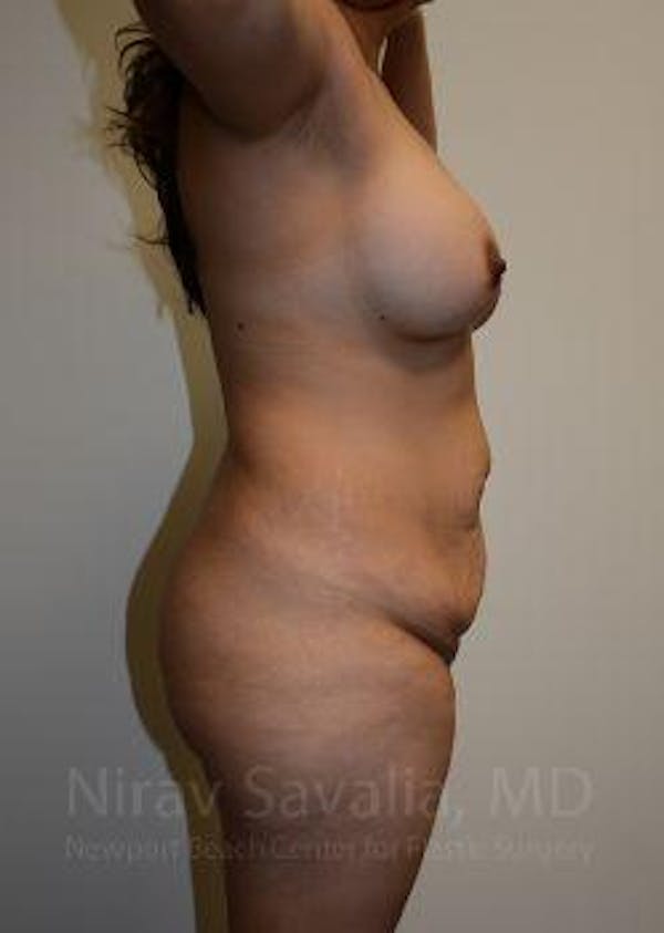 Mommy Makeover Before & After Gallery - Patient 1655618 - Before1