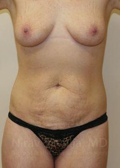 Abdominoplasty Tummy Tuck Before & After Gallery - Patient 1655627