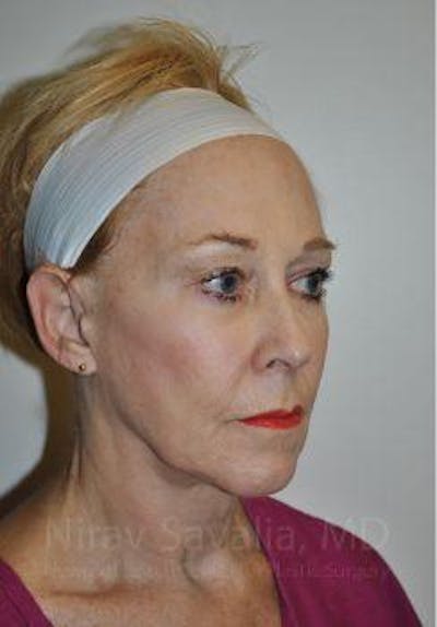 Liposuction Before & After Gallery - Patient 1655625