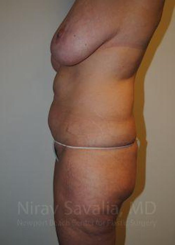 Body Contouring after Weight Loss Before & After Gallery - Patient 1655628 - Before1