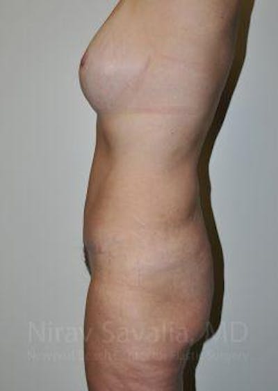 Body Contouring after Weight Loss Before & After Gallery - Patient 1655628 - After1