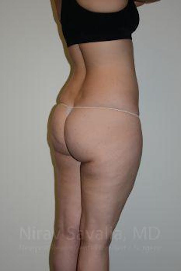 Liposuction Before & After Gallery - Patient 1655629 - Before1