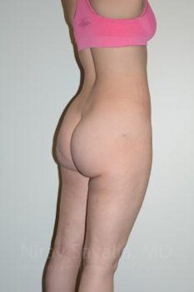 Liposuction Before & After Gallery - Patient 1655629 - After1