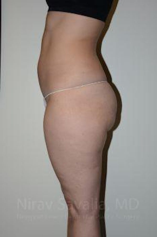 Liposuction Before & After Gallery - Patient 1655629 - Before1