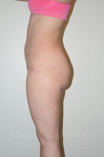 Liposuction Before & After Gallery - Patient 1655629 - After1