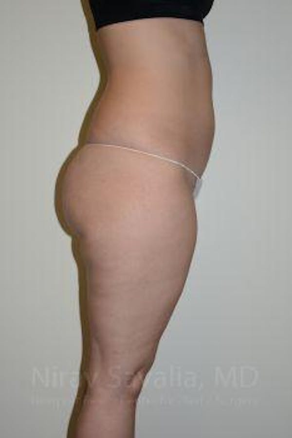 Liposuction Before & After Gallery - Patient 1655629 - Before1