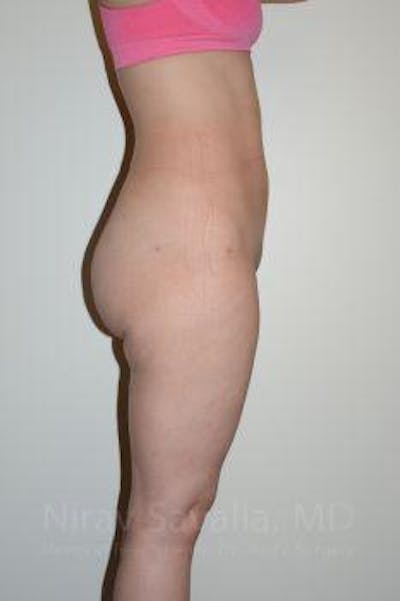 Liposuction Before & After Gallery - Patient 1655629 - After1