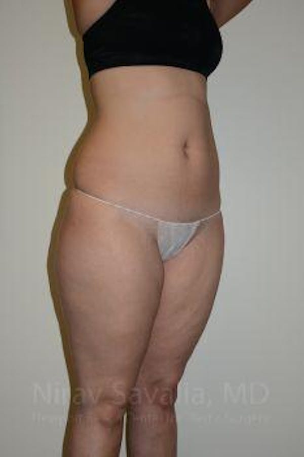 Liposuction Before & After Gallery - Patient 1655629 - Before1