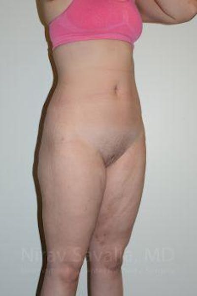 Liposuction Before & After Gallery - Patient 1655629 - After1