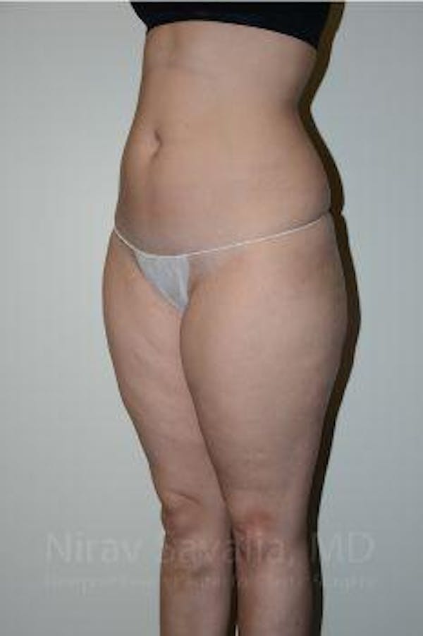 Liposuction Before & After Gallery - Patient 1655629 - Before1