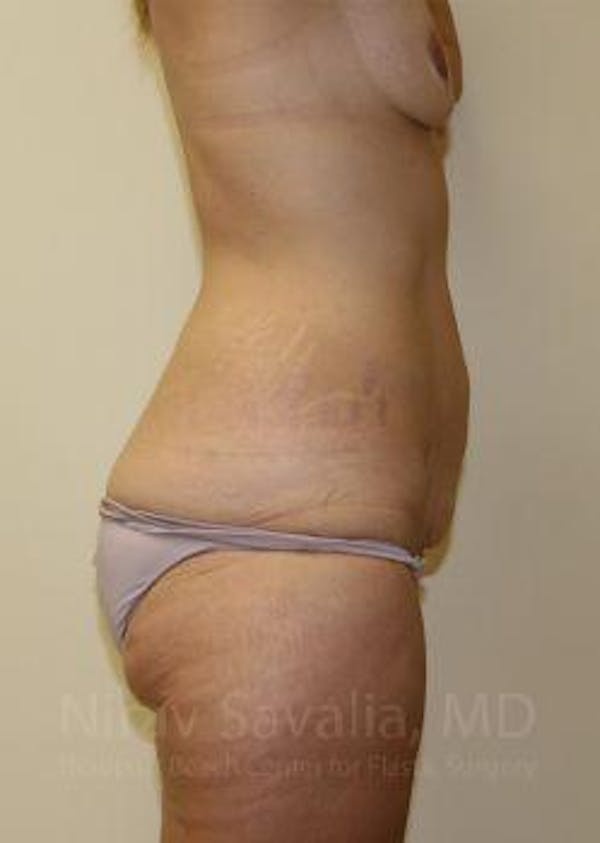 Abdominoplasty Tummy Tuck Before & After Gallery - Patient 1655631 - Before1
