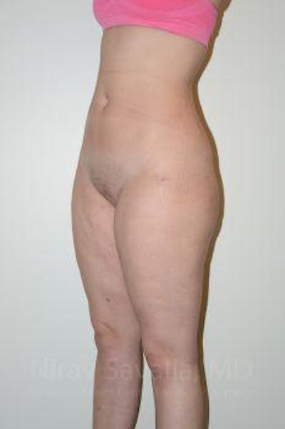 Liposuction Before & After Gallery - Patient 1655629 - After1