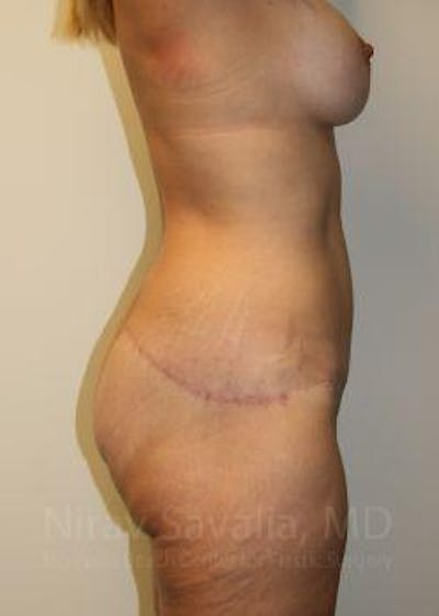 Abdominoplasty Tummy Tuck Before & After Gallery - Patient 1655631 - After1