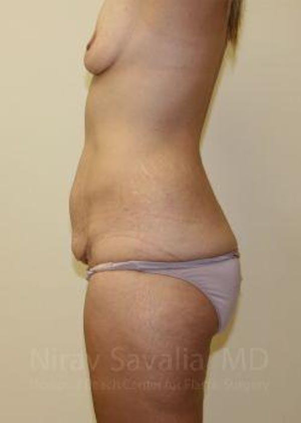 Abdominoplasty Tummy Tuck Before & After Gallery - Patient 1655631 - Before1