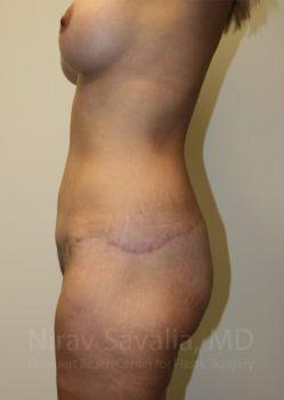 Abdominoplasty Tummy Tuck Before & After Gallery - Patient 1655631 - After1