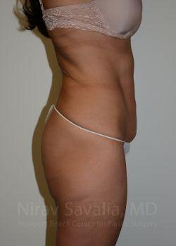 Body Contouring after Weight Loss Before & After Gallery - Patient 1655633 - Before1