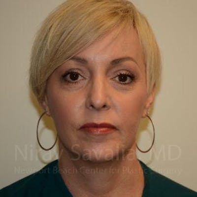 Liposuction Before & After Gallery - Patient 1655632