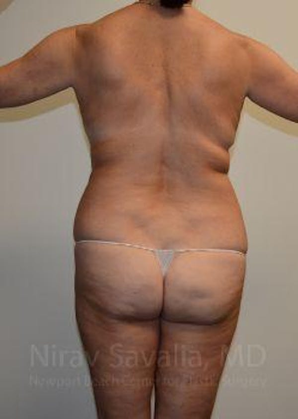 Mommy Makeover Before & After Gallery - Patient 1655635 - Before1