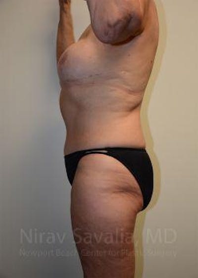 Abdominoplasty Tummy Tuck Before & After Gallery - Patient 1655634 - After1