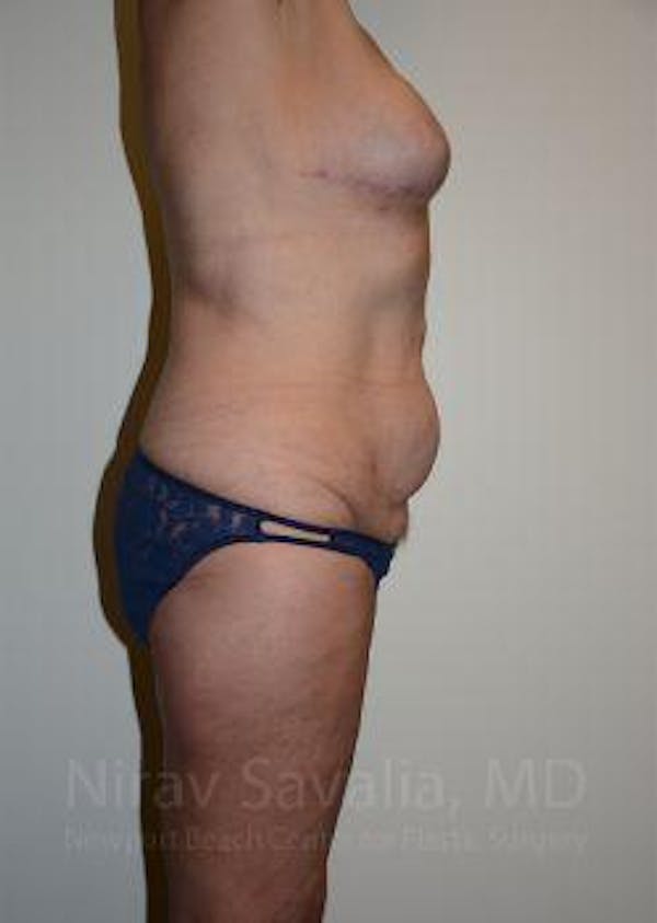 Abdominoplasty Tummy Tuck Before & After Gallery - Patient 1655634 - Before1
