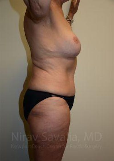 Abdominoplasty Tummy Tuck Before & After Gallery - Patient 1655634 - After1