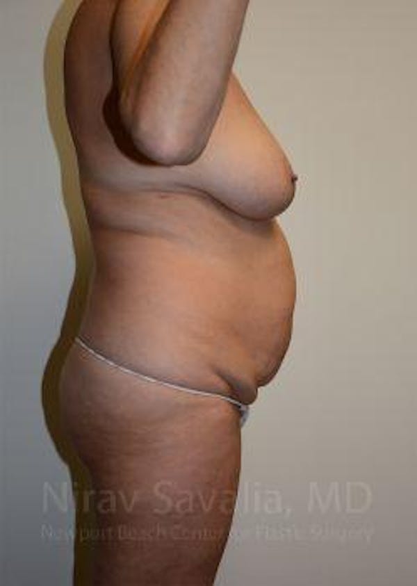 Mommy Makeover Before & After Gallery - Patient 1655635 - Before1