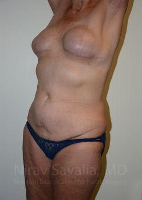 Abdominoplasty Tummy Tuck Before & After Gallery - Patient 1655634 - Before1