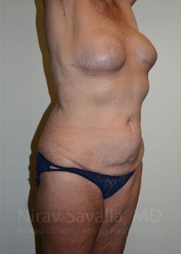 Abdominoplasty Tummy Tuck Before & After Gallery - Patient 1655634 - Before1