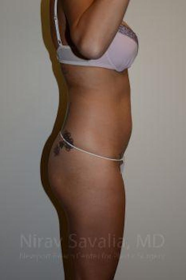 Liposuction Before & After Gallery - Patient 1655637 - Before1