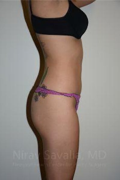Liposuction Before & After Gallery - Patient 1655637 - After1