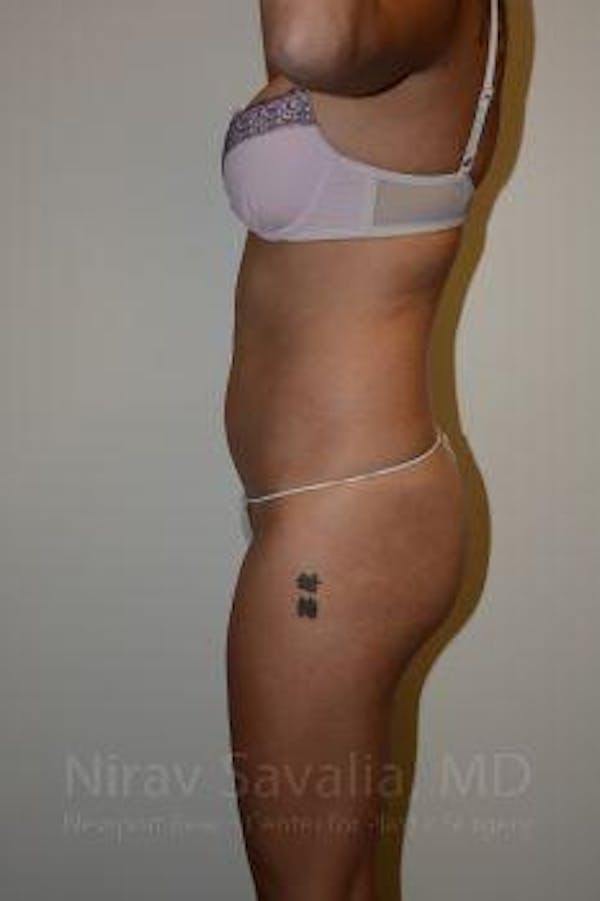 Liposuction Before & After Gallery - Patient 1655637 - Before1
