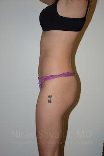 Liposuction Before & After Gallery - Patient 1655637 - After1