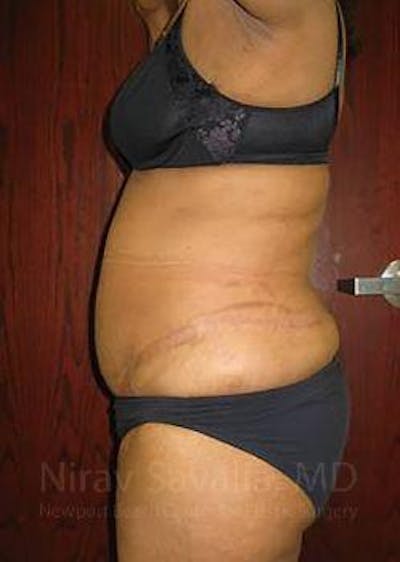 Body Contouring after Weight Loss Before & After Gallery - Patient 1655636 - After1