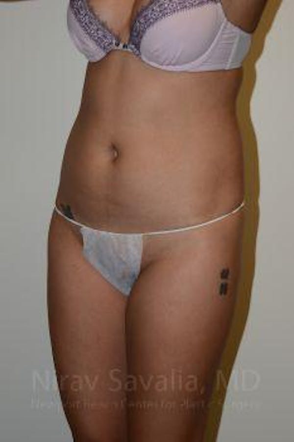 Liposuction Before & After Gallery - Patient 1655637 - Before1