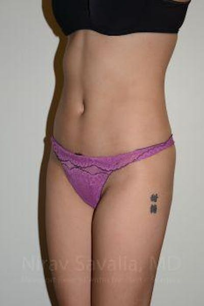 Liposuction Before & After Gallery - Patient 1655637 - After1
