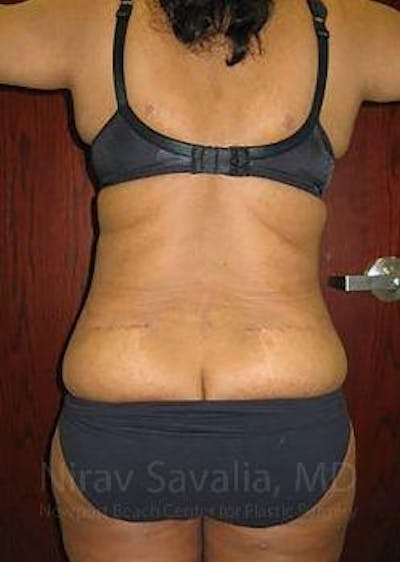 Body Contouring after Weight Loss Before & After Gallery - Patient 1655636 - After1