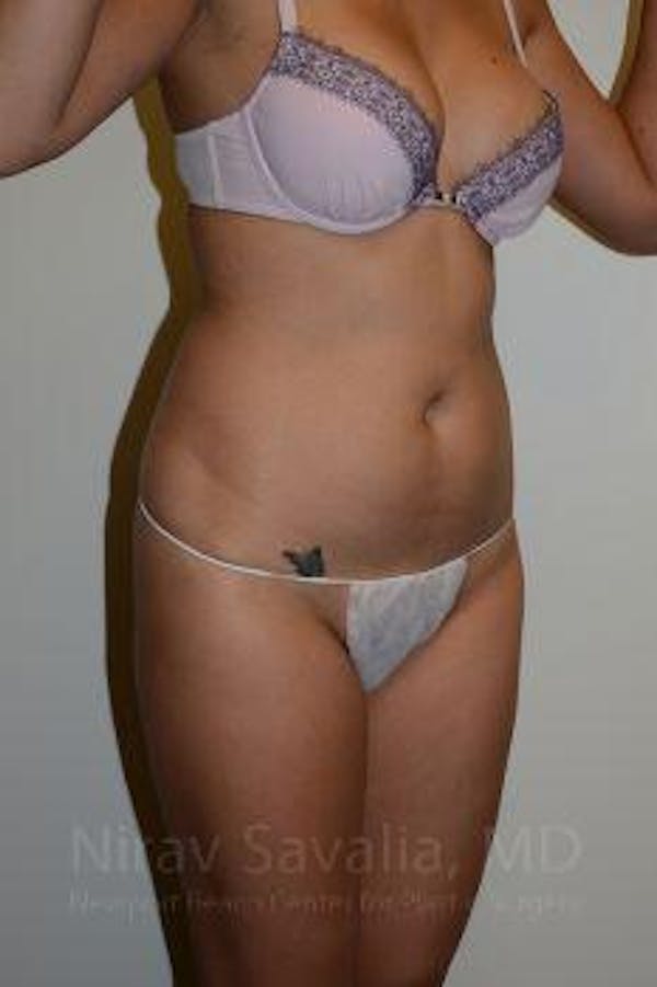 Liposuction Before & After Gallery - Patient 1655637 - Before1