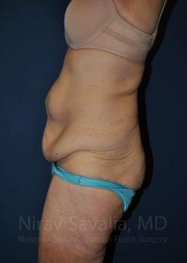 Abdominoplasty Tummy Tuck Before & After Gallery - Patient 1655638 - Before1