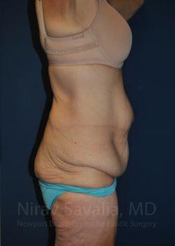 Body Contouring after Weight Loss Before & After Gallery - Patient 1655640 - Before1