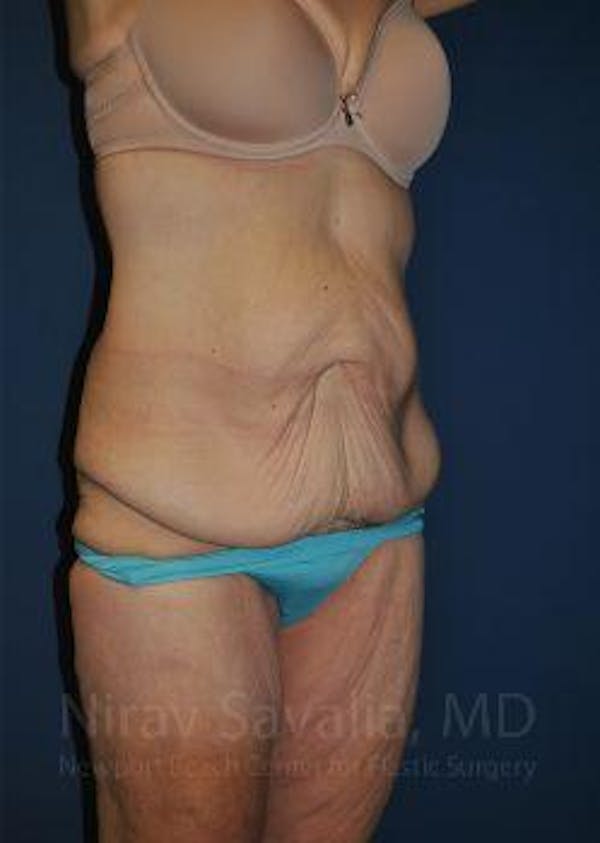 Body Contouring after Weight Loss Before & After Gallery - Patient 1655640 - Before1